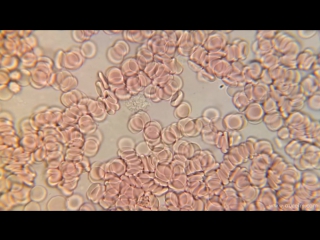 blood on 1000x microscope hd 1080p