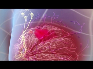 breast cancer - animation