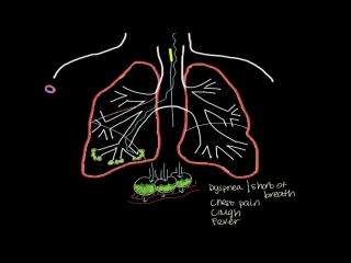 what is pneumonia